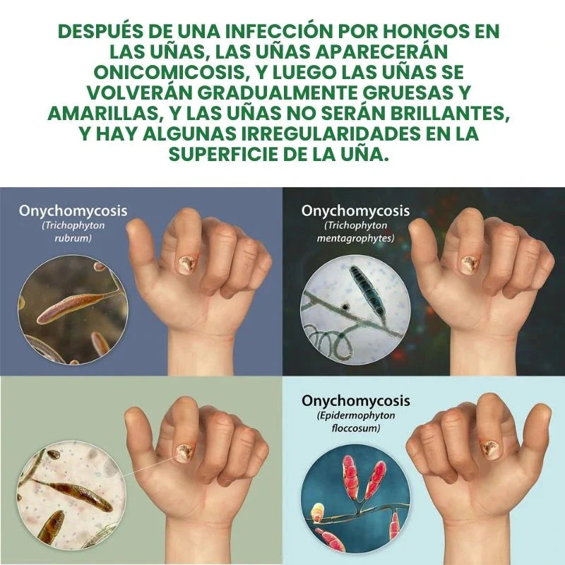 7 Days Fungus Free Nails® - Protege y elimina el hongo de tus Uñas.