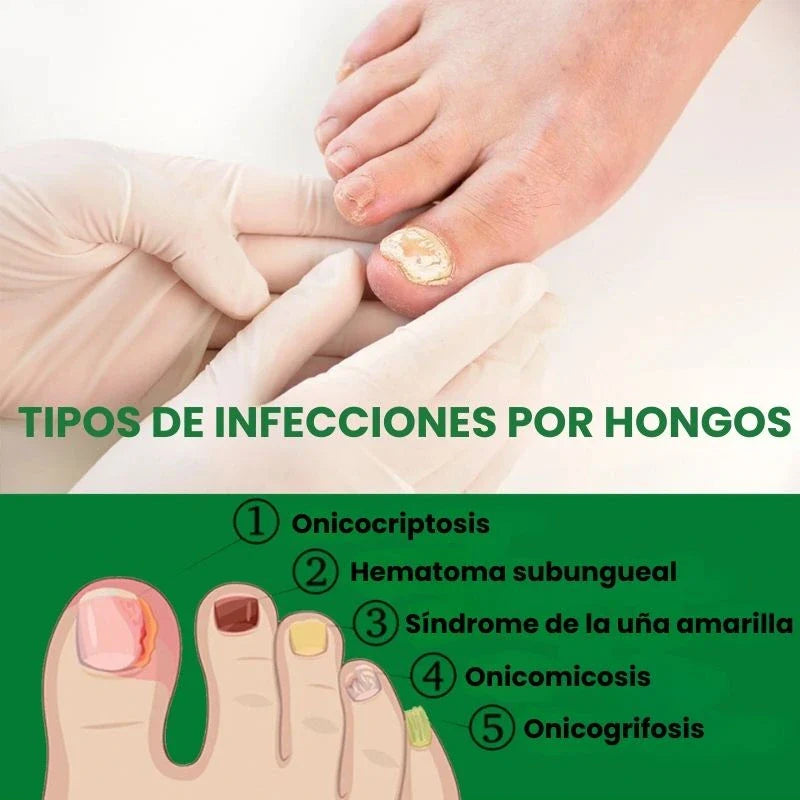 7 Days Fungus Free Nails® - Protege y elimina el hongo de tus Uñas.